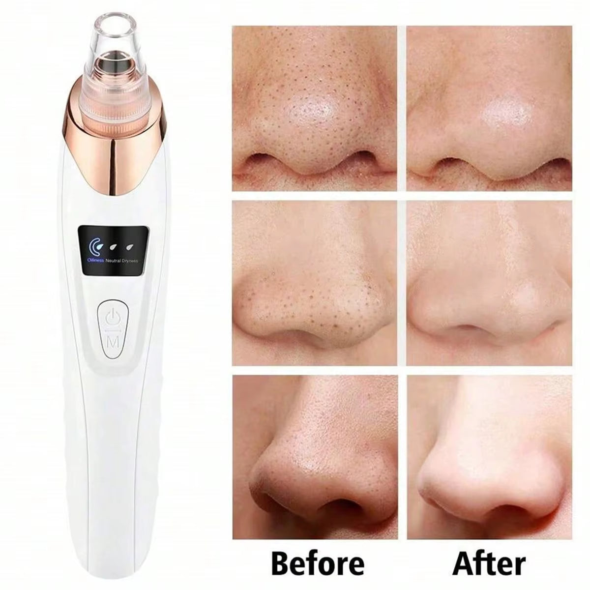 Limpiador Facial de Poros al Vacío Recargable | Removedor de Puntos Negros con 5 Cabezales